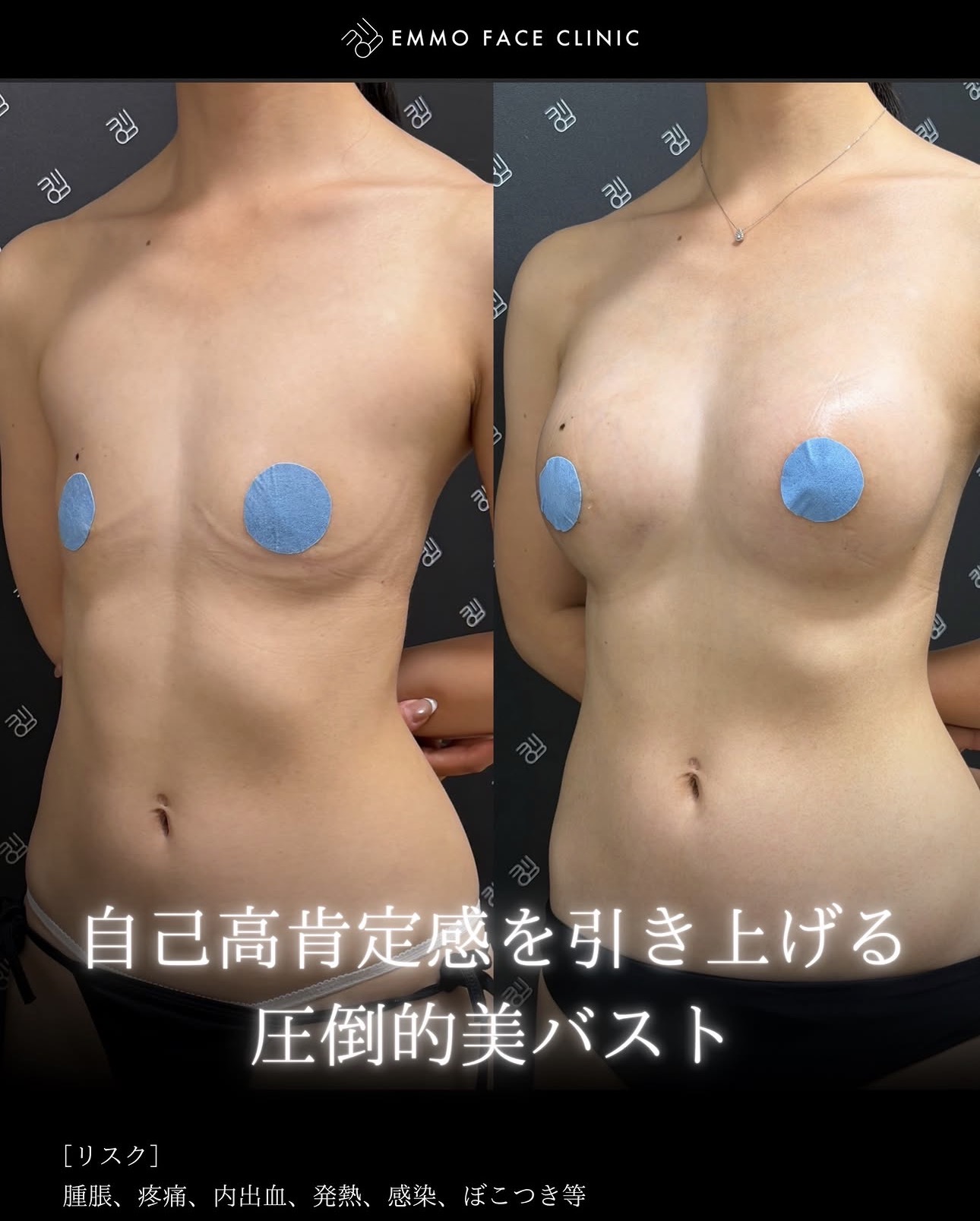 豊胸ー症例写真