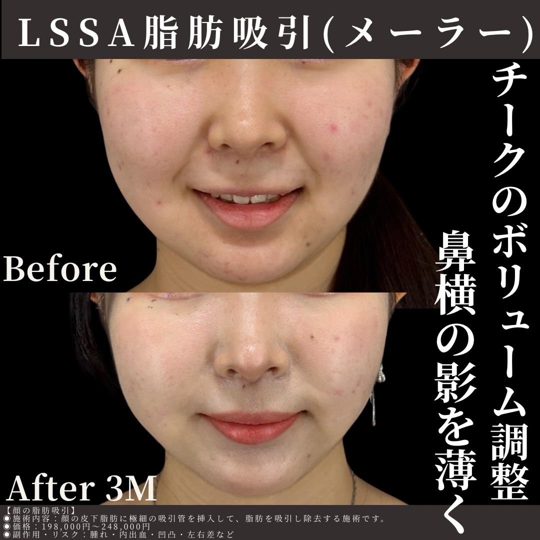 LSSA脂肪吸引