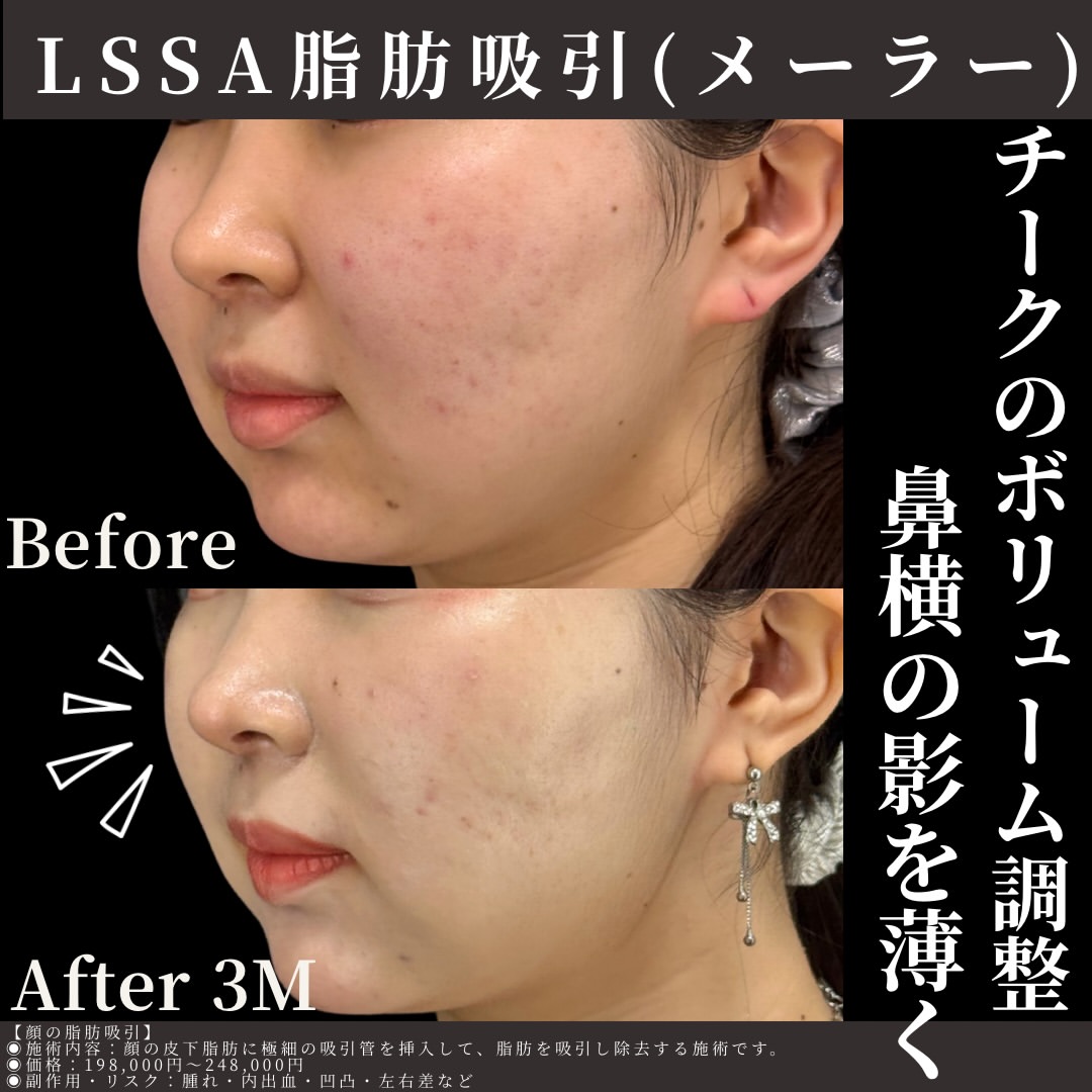 LSSA脂肪吸引
