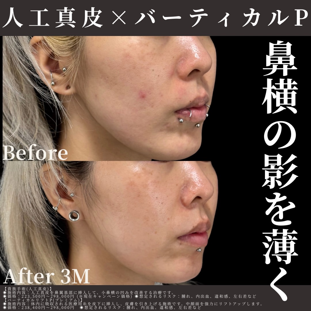 人工真皮×バーティカルリフト