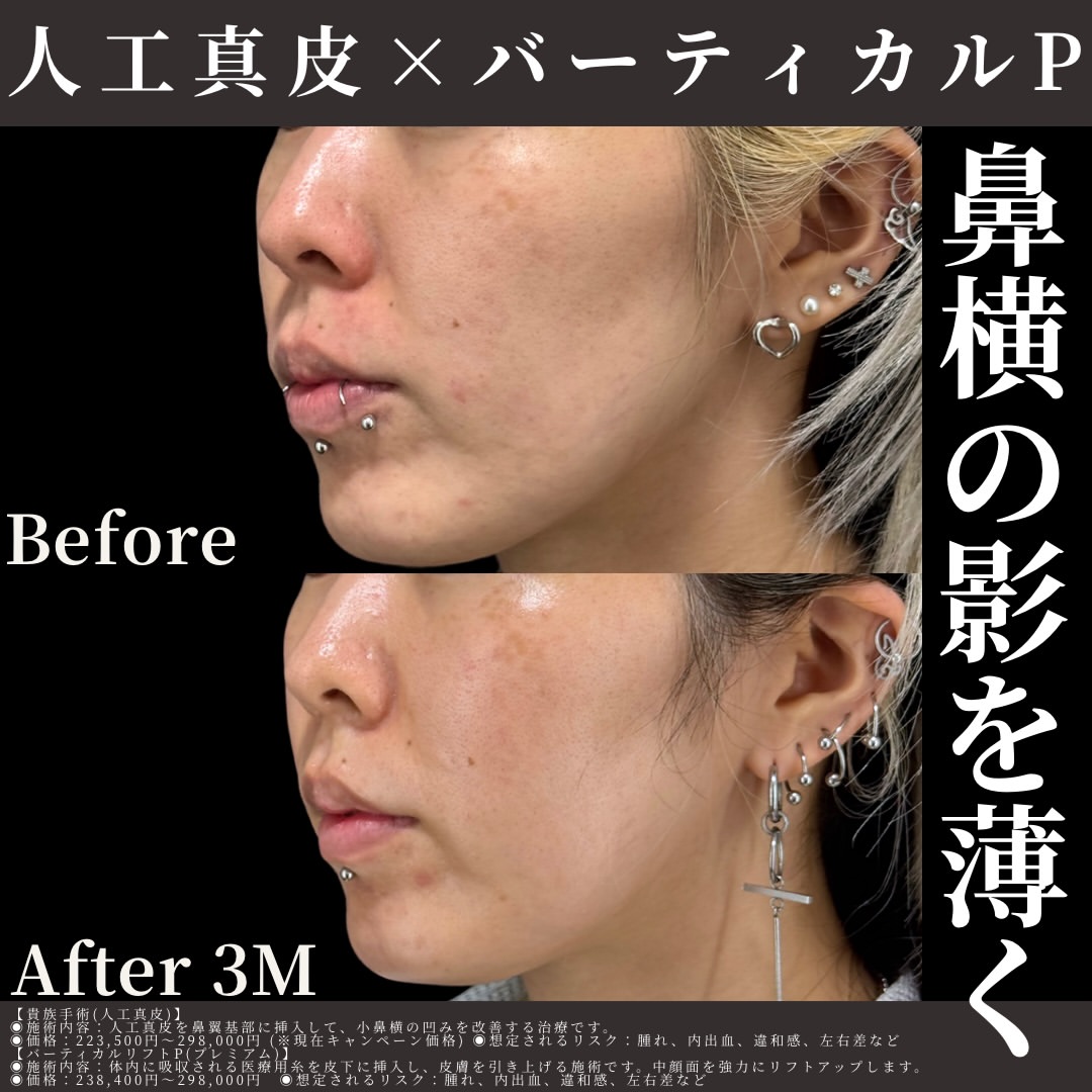 人工真皮×バーティカルリフト