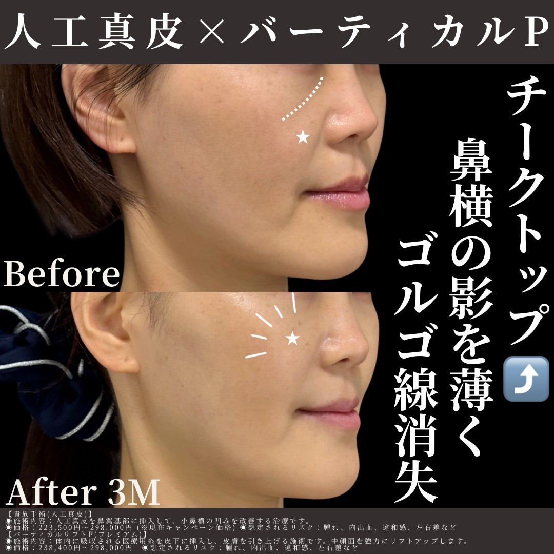 人工真皮×バーティカルリフトプレミアム