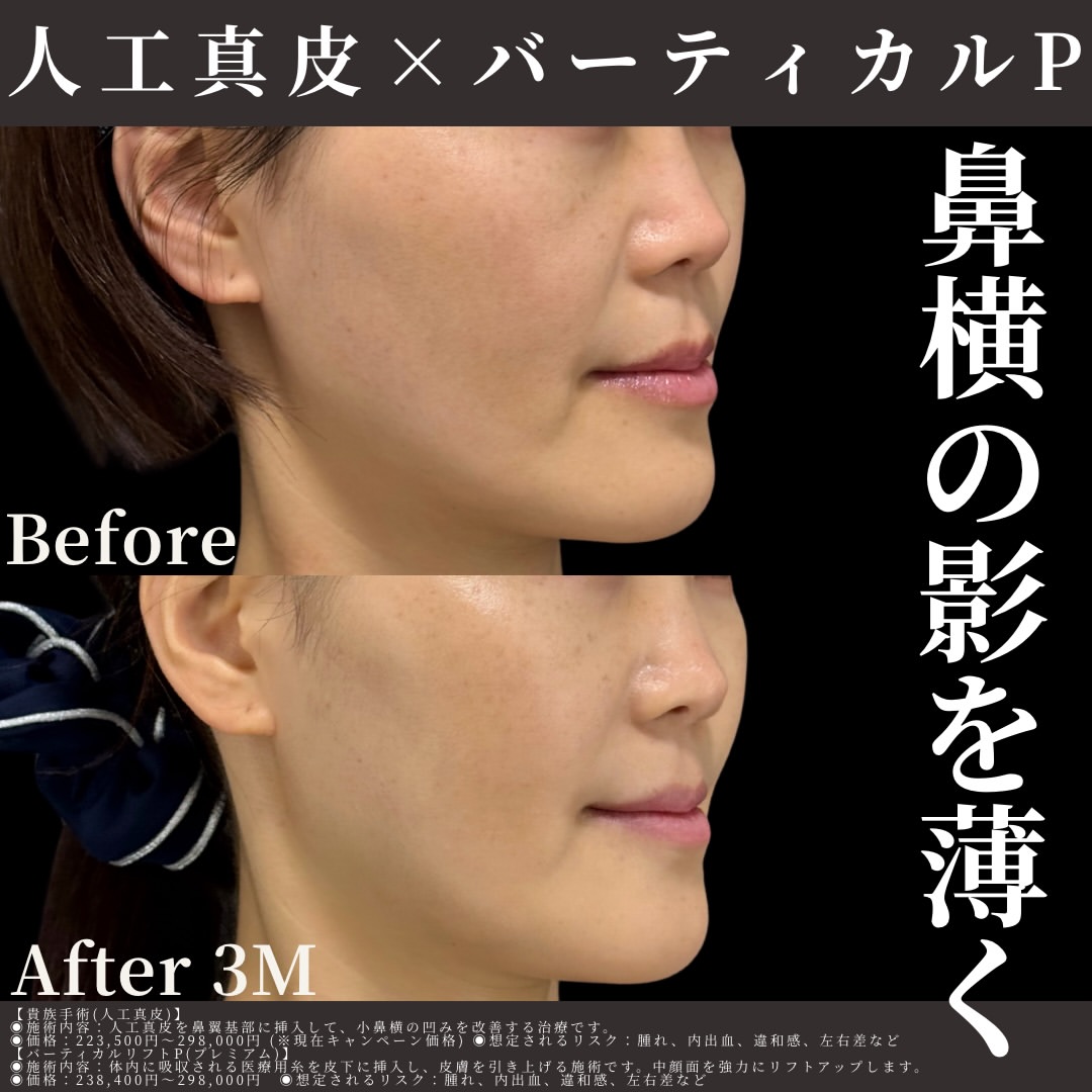 人工真皮×バーティカルリフトプレミアム