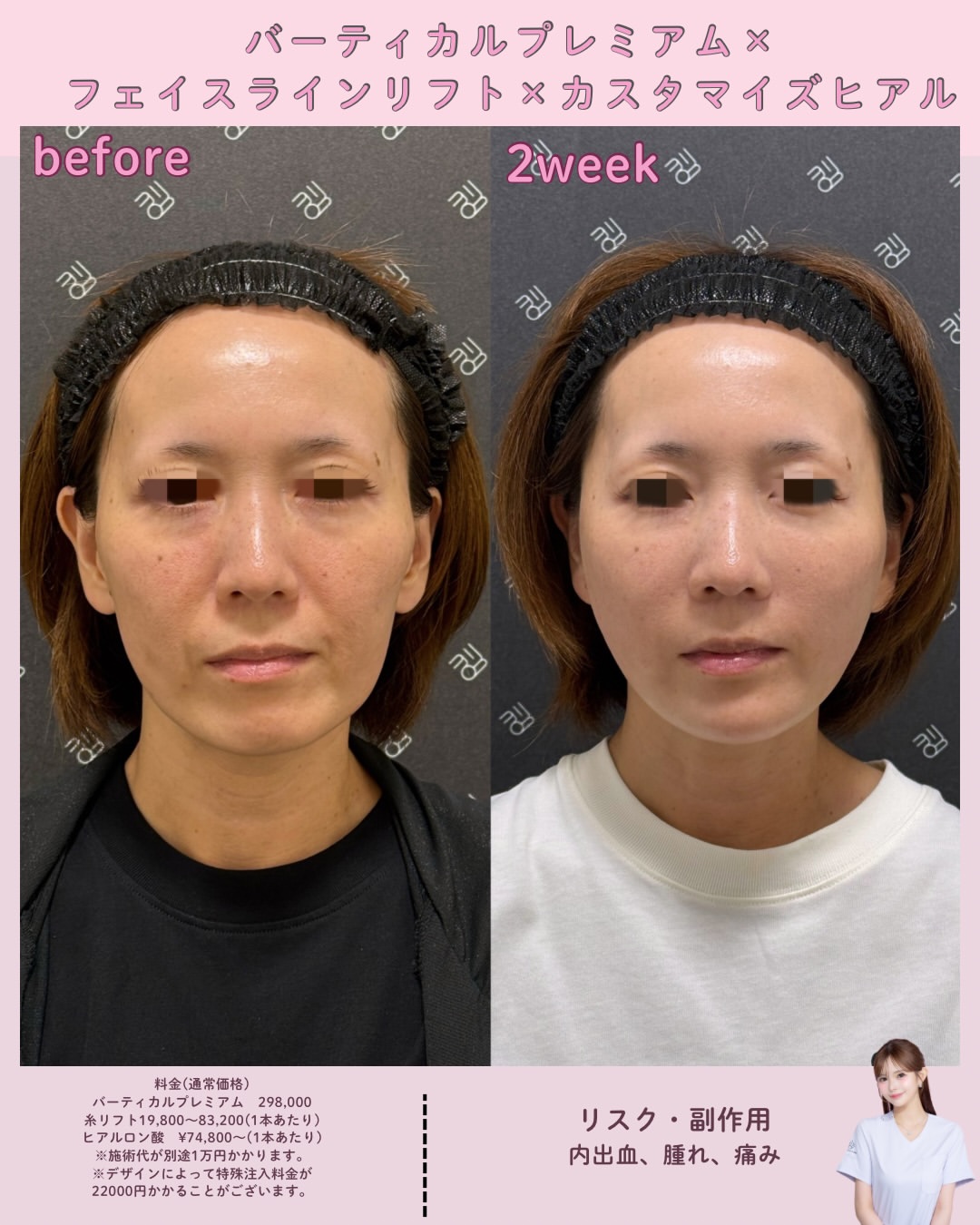 バーティカルリフトプレミアム×糸リフト×ヒアルロン酸