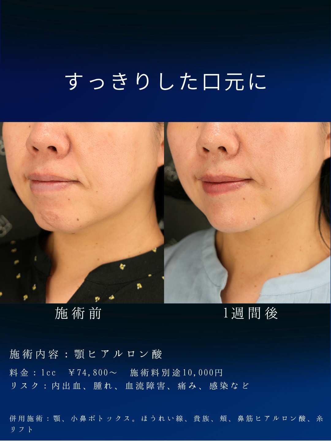 ヒアルロン酸