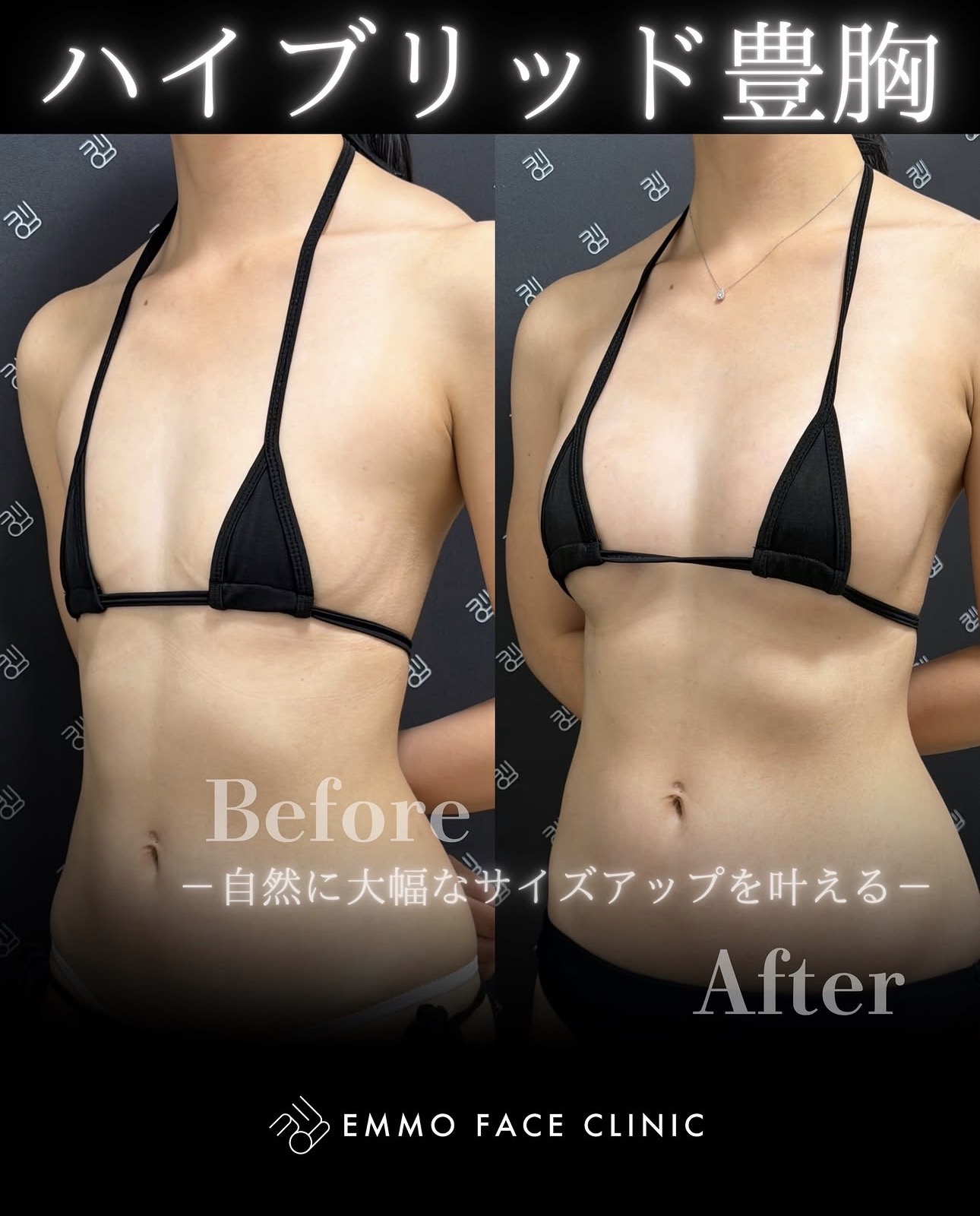 ハイブリッド豊胸ー症例写真