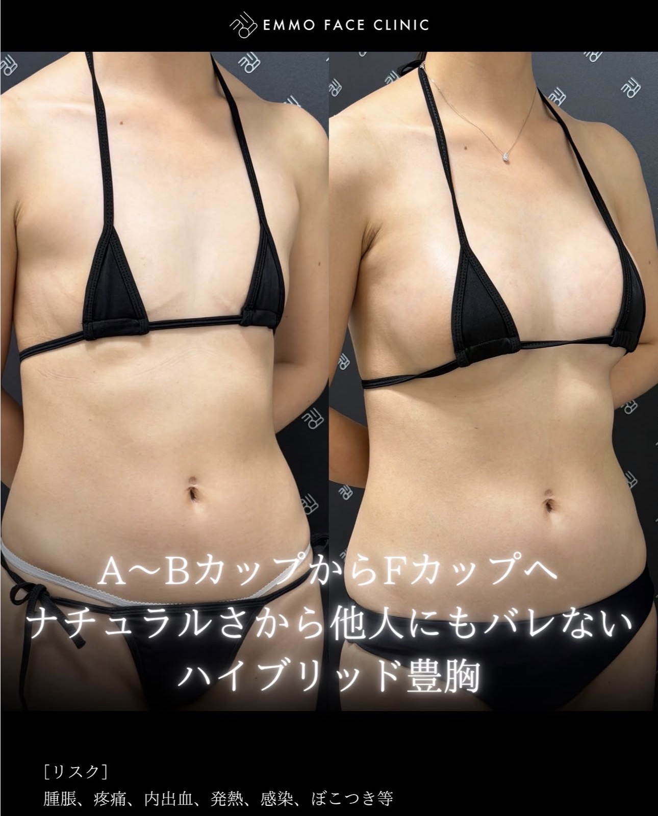 ハイブリッド豊胸ー症例写真