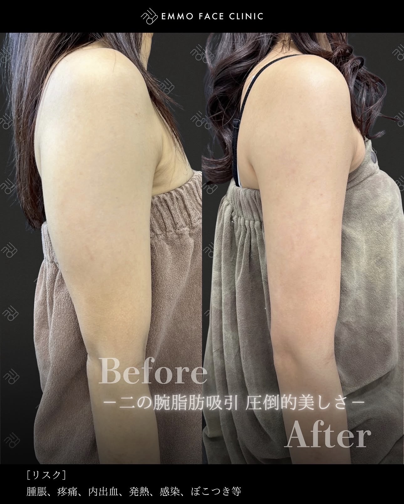 二の腕脂肪吸引ー症例写真