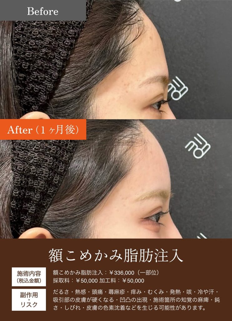 額こめかみ脂肪注入の症例1