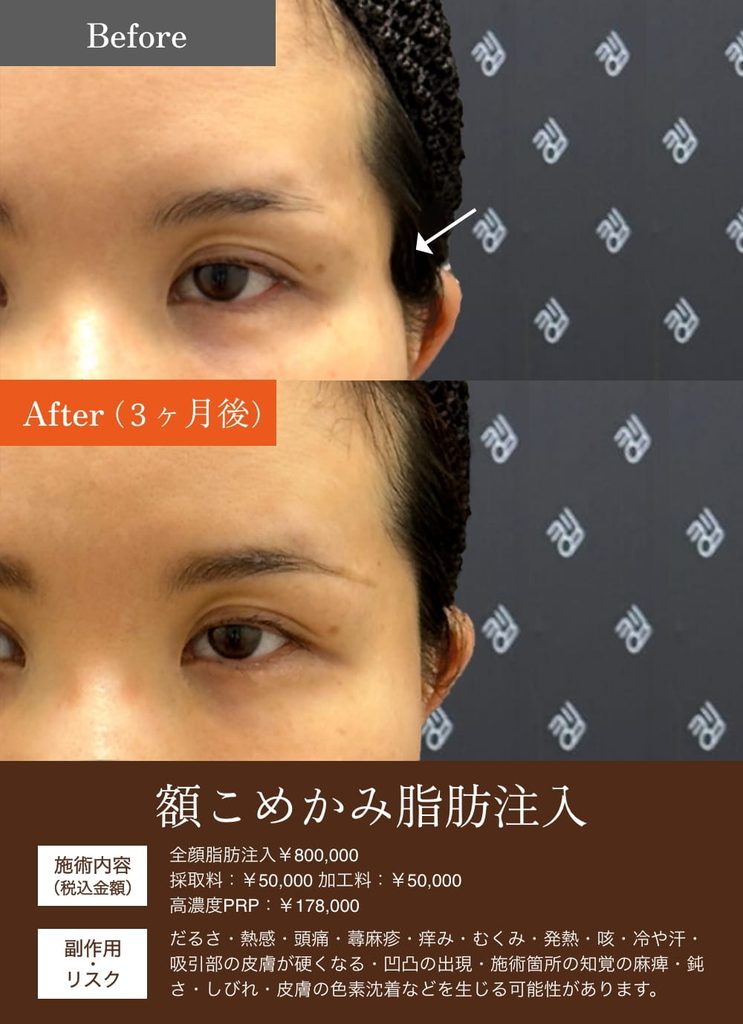 額こめかみ脂肪注入の症例1/ファイル名