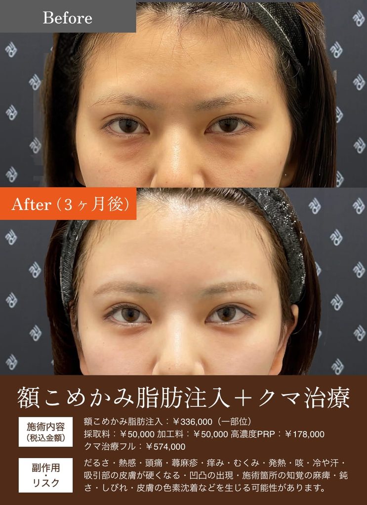 額こめかみ脂肪注入の症例2