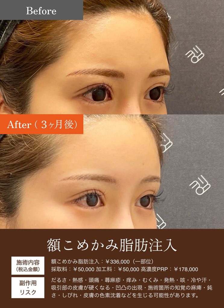 額こめかみ脂肪注入の症例2