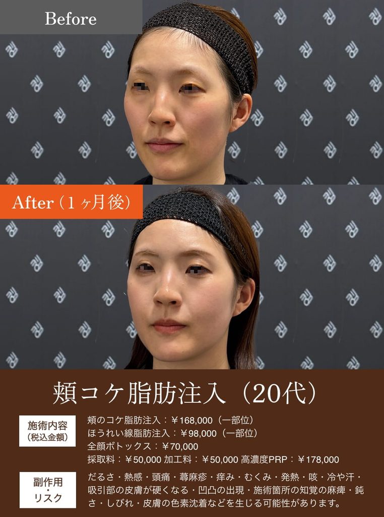 ほうれい線脂肪注入の症例2