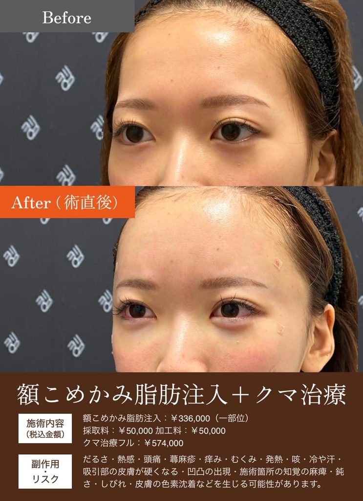 額こめかみ脂肪注入の症例3