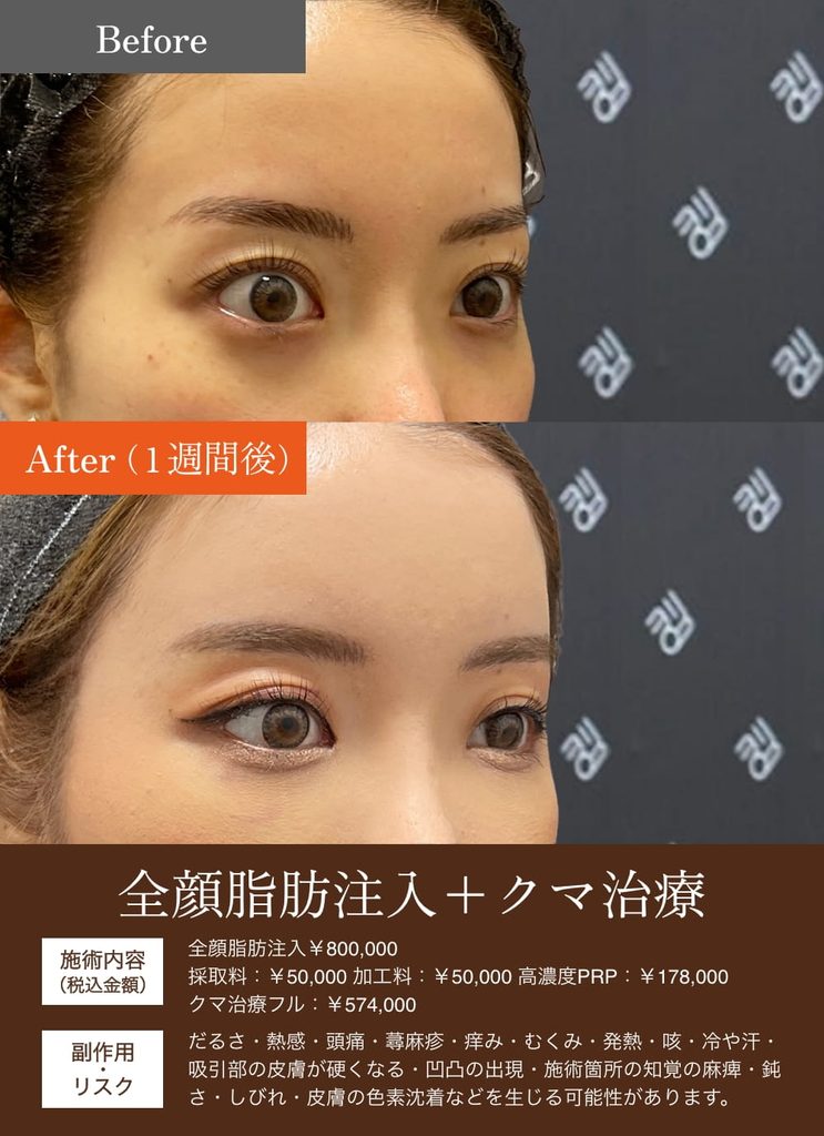 額こめかみ脂肪注入の症例4