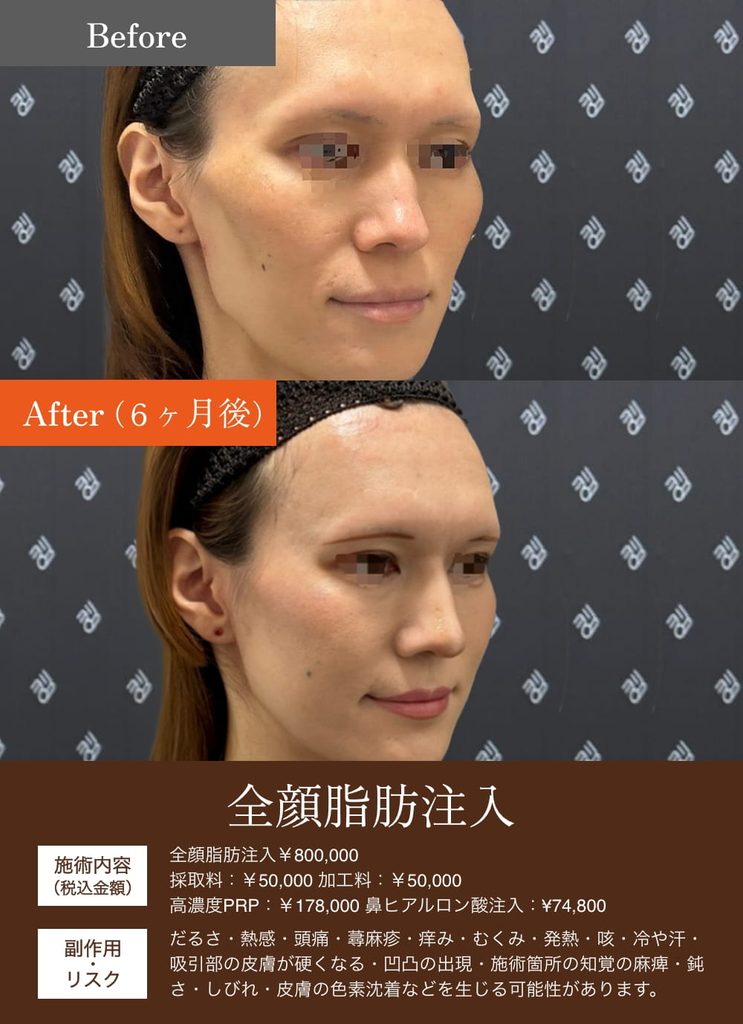 額こめかみ脂肪注入の症例5