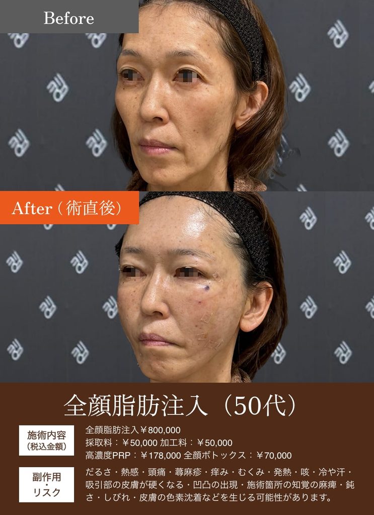 額こめかみ脂肪注入の症例6