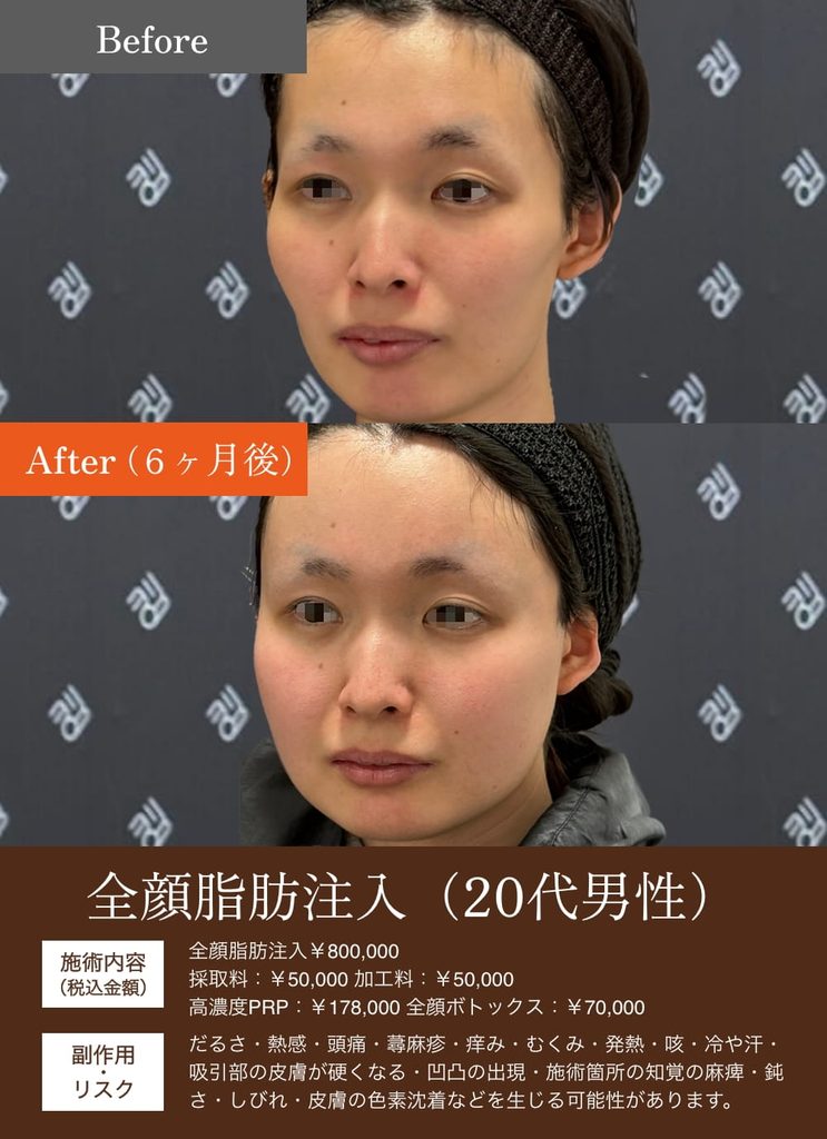 額こめかみ脂肪注入の症例7