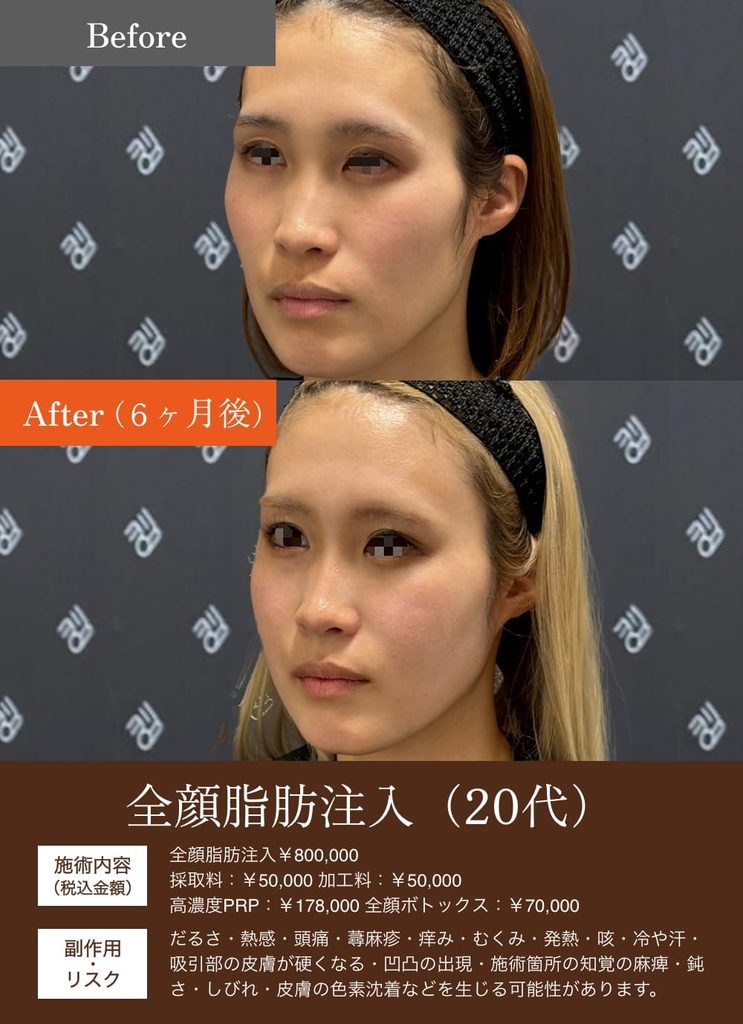 額こめかみ脂肪注入の症例8