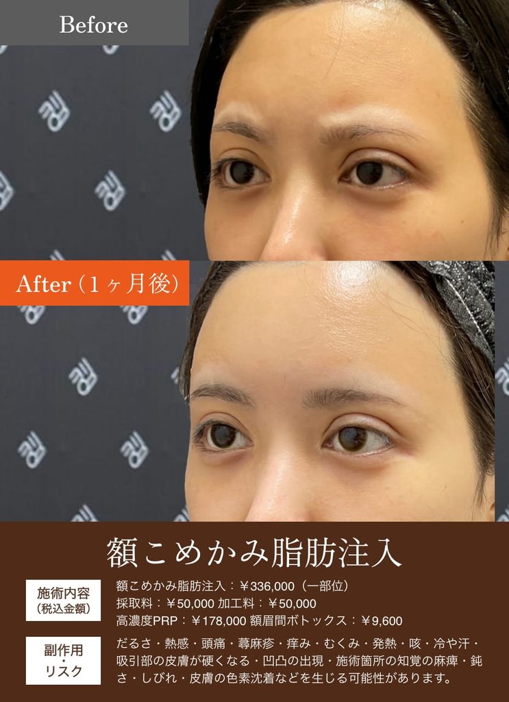 額こめかみ脂肪注入の症例9