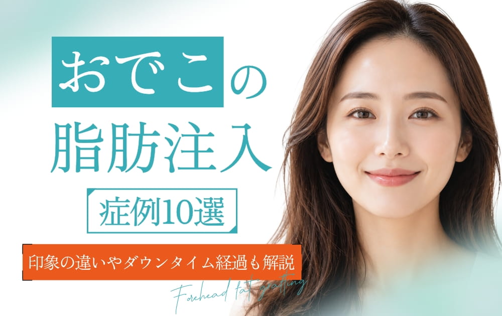おでこの脂肪注入の文字と丸みのあるおでこの女性