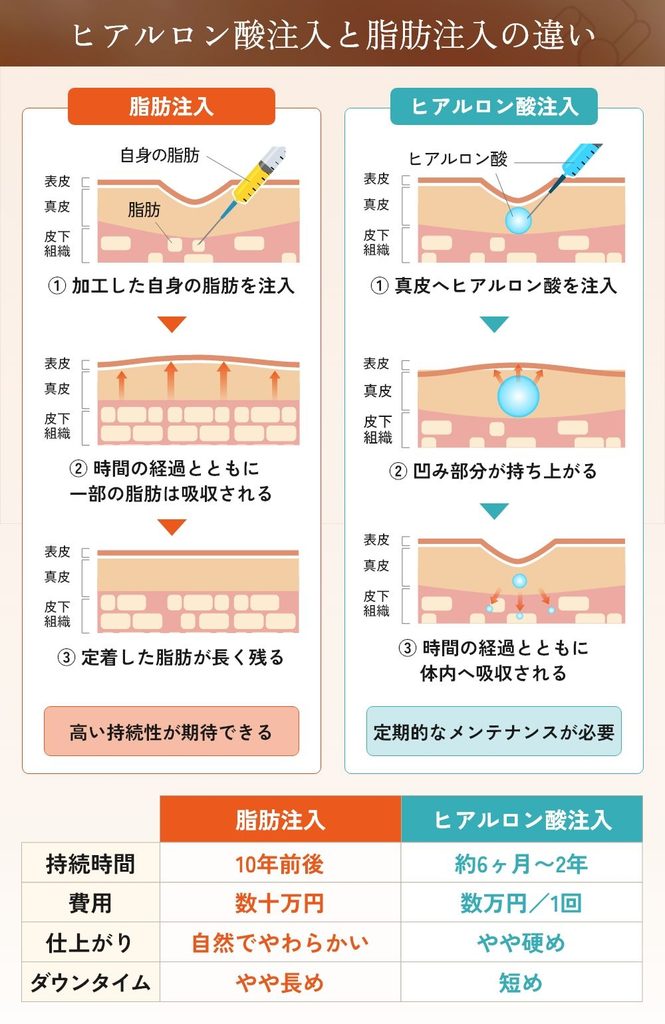 脂肪注入とヒアルロン酸注入の違いを比較したイラストと表