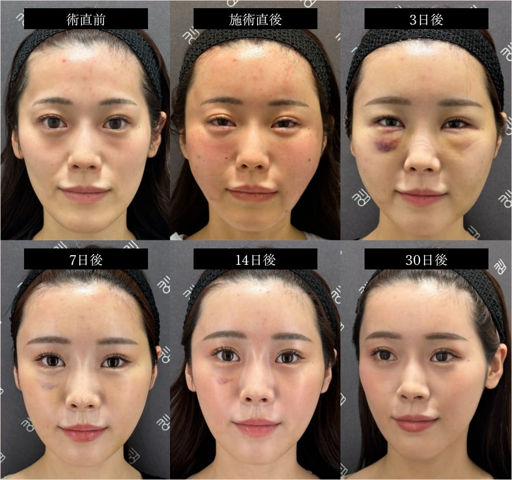 脂肪注入のダウンタイム経過