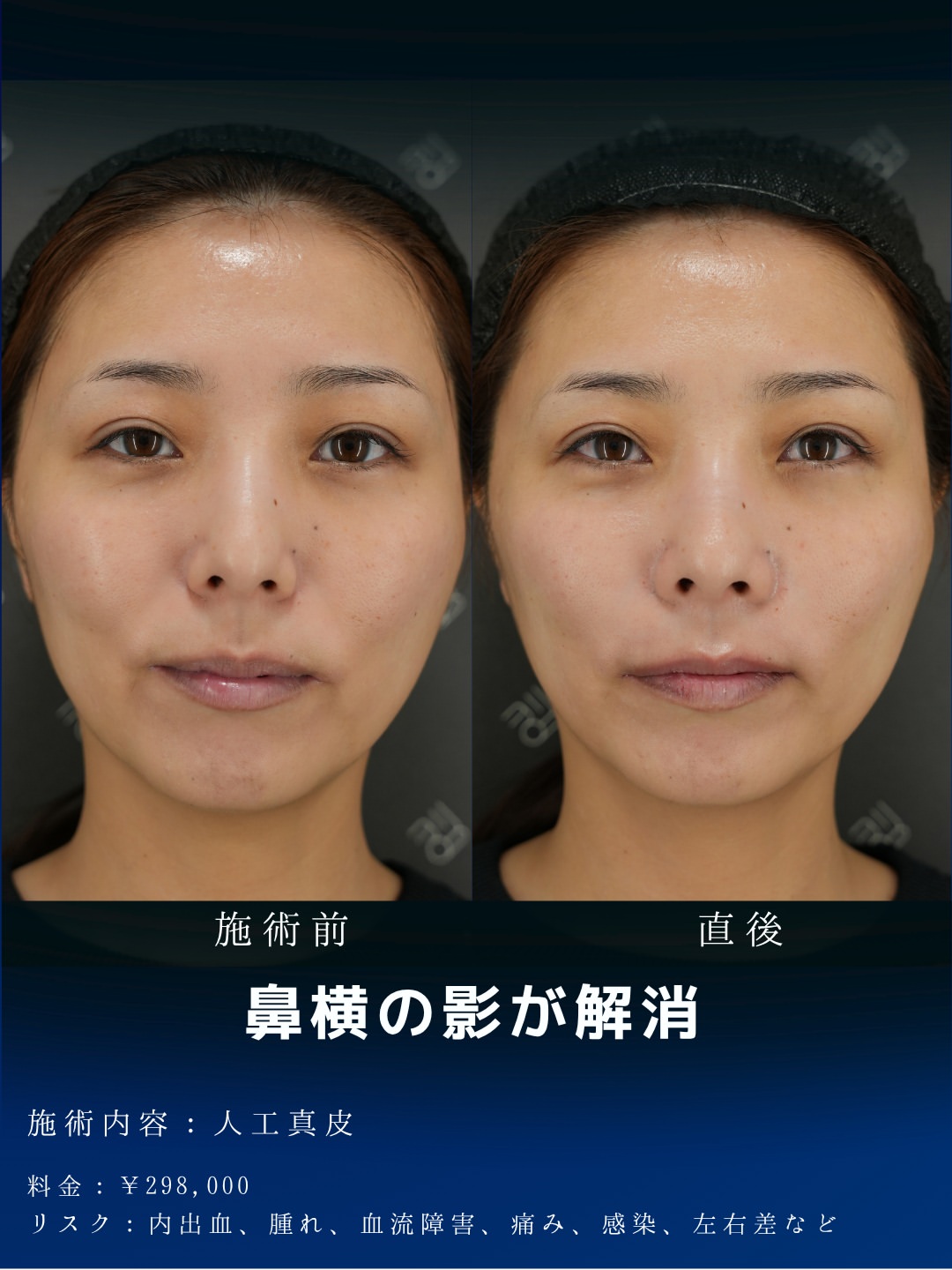 人工真皮
