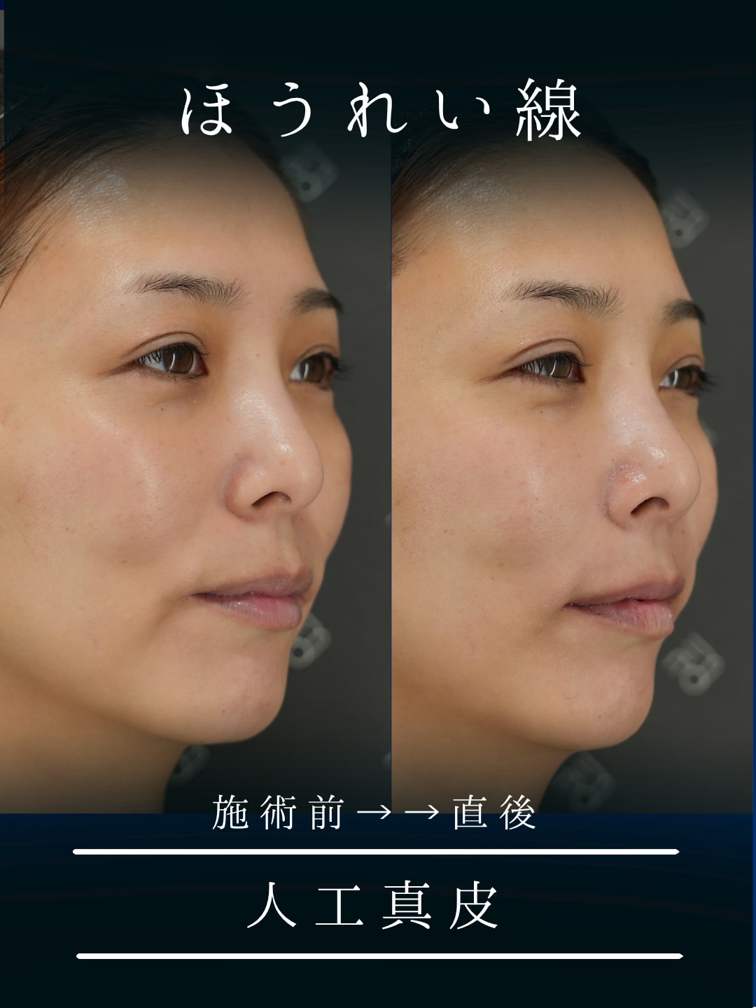 人工真皮