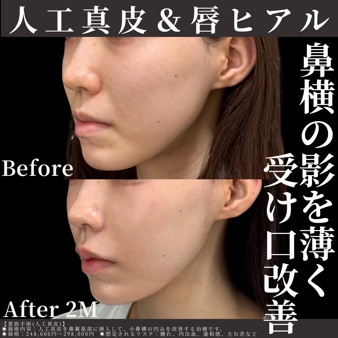 人工真皮×唇ヒアルロン酸