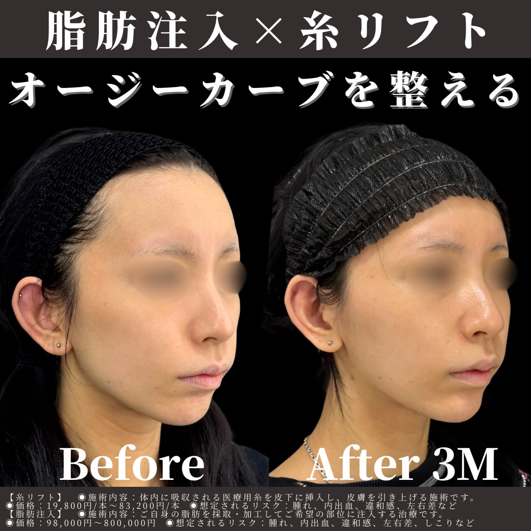 脂肪注入×糸リフト