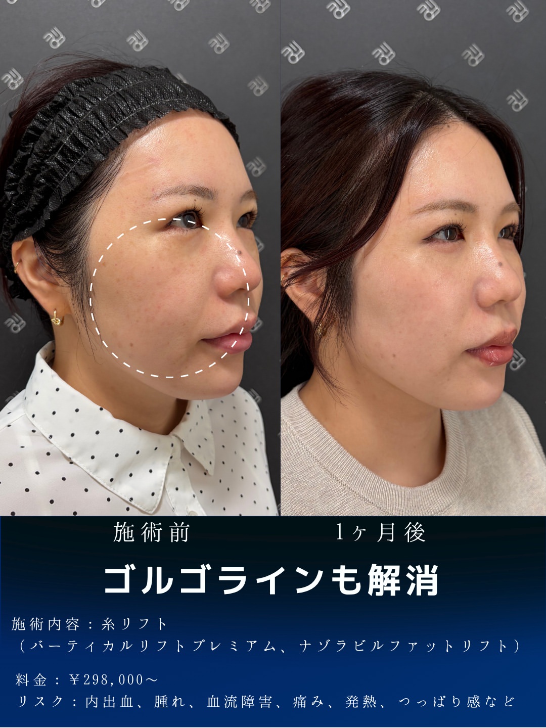 バーティカルリフト