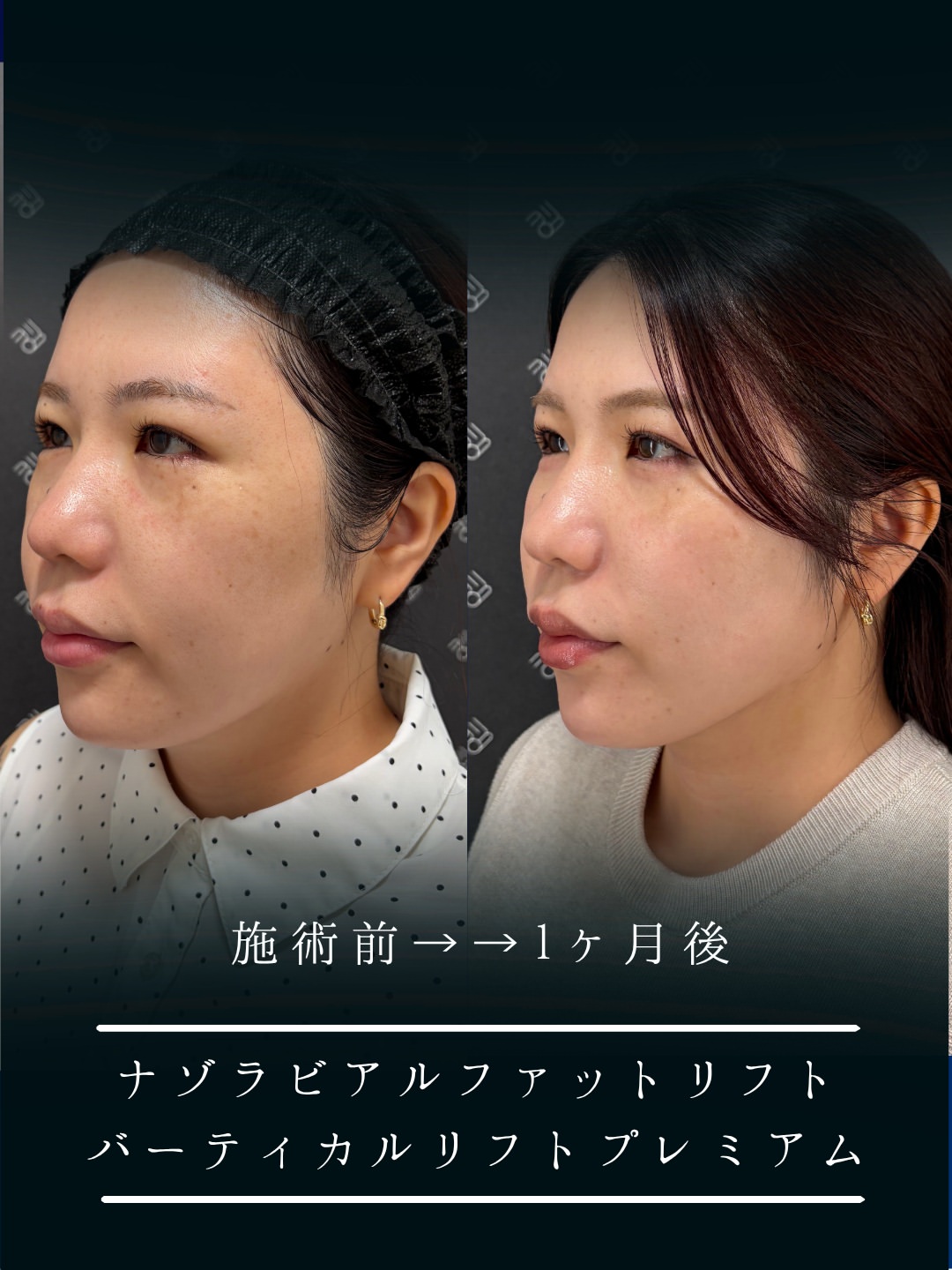 バーティカルリフト