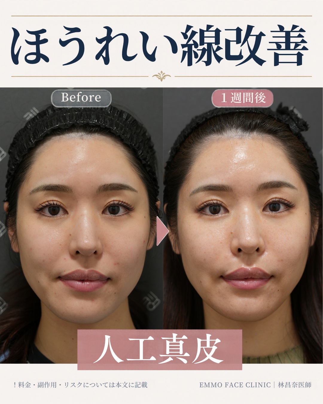人工真皮