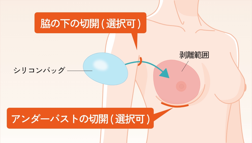 シリコンバッグ豊胸の切開位置とバッグを挿入する位置を示したイラスト
