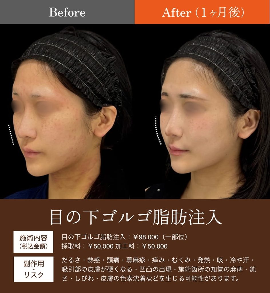 目の下ゴルゴ脂肪注入の症例