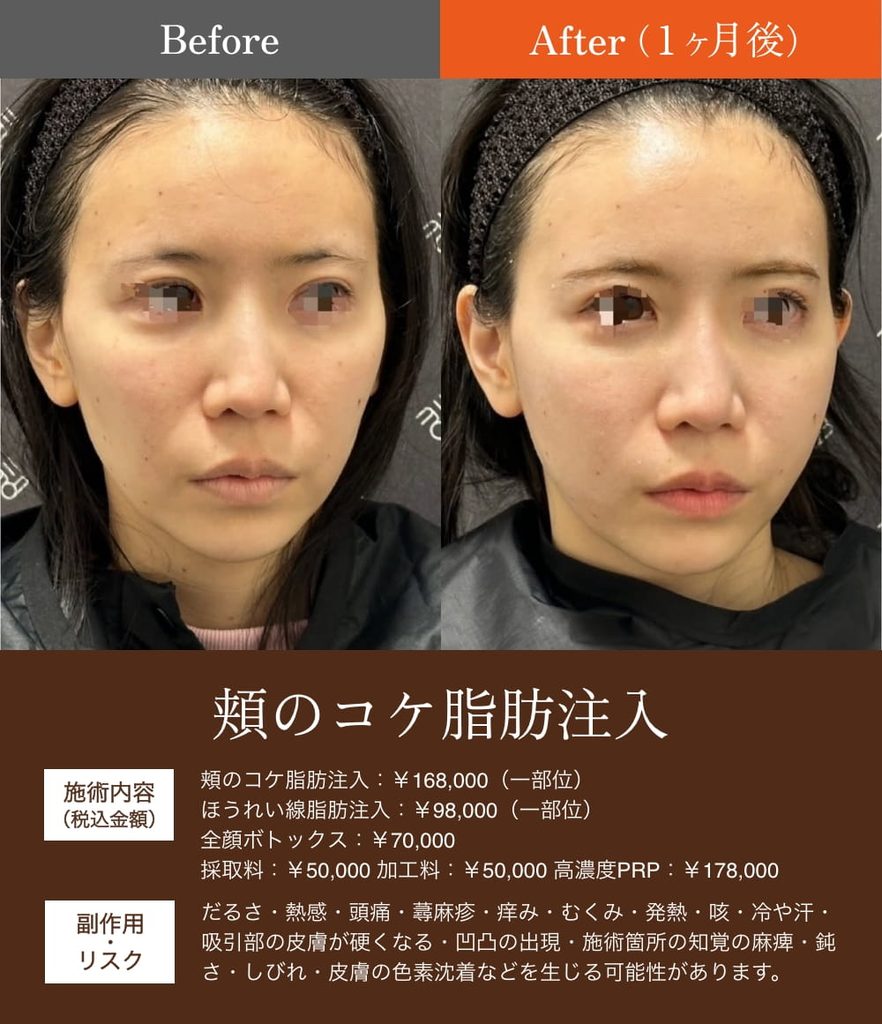 頬こけ脂肪注入の症例