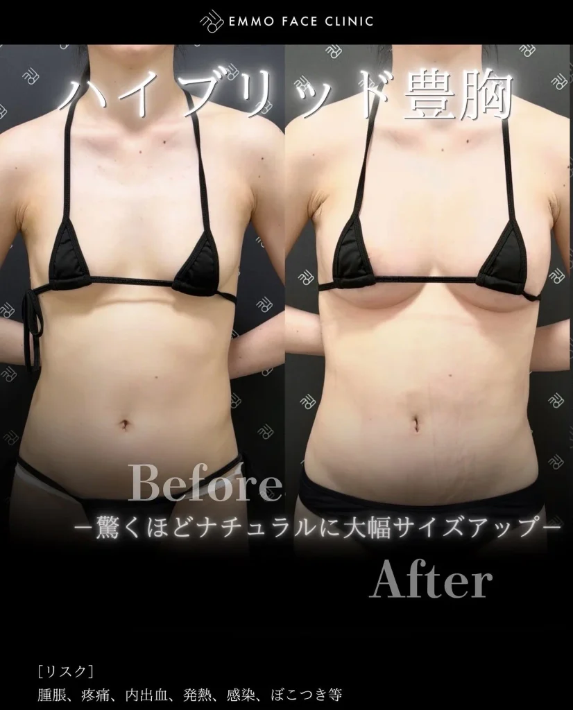 ハイブリッド豊胸の症例写真03