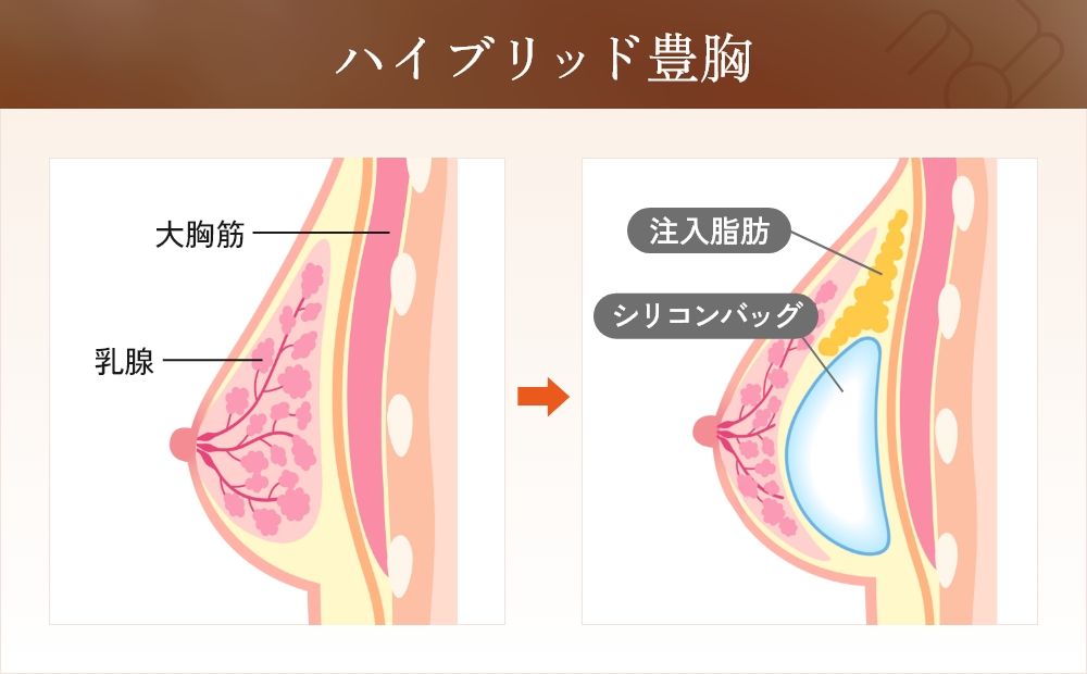 ハイブリッド豊胸の術前と術後を比較したバストの変化イラスト
