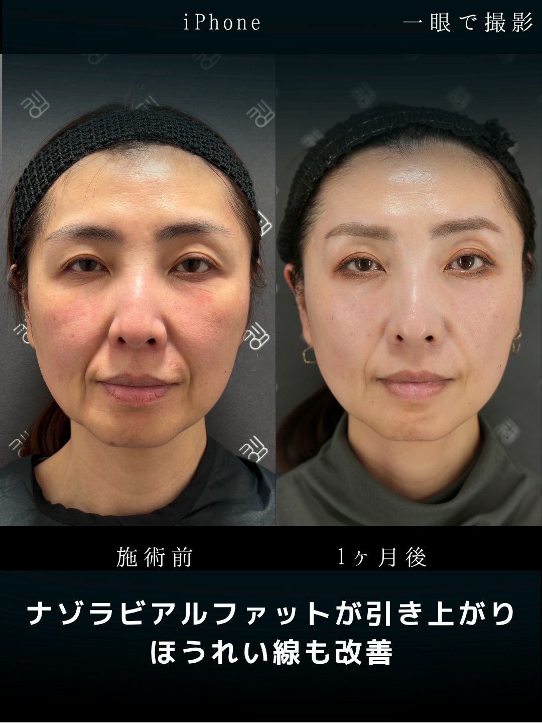 バーティカルリフトプレミアム