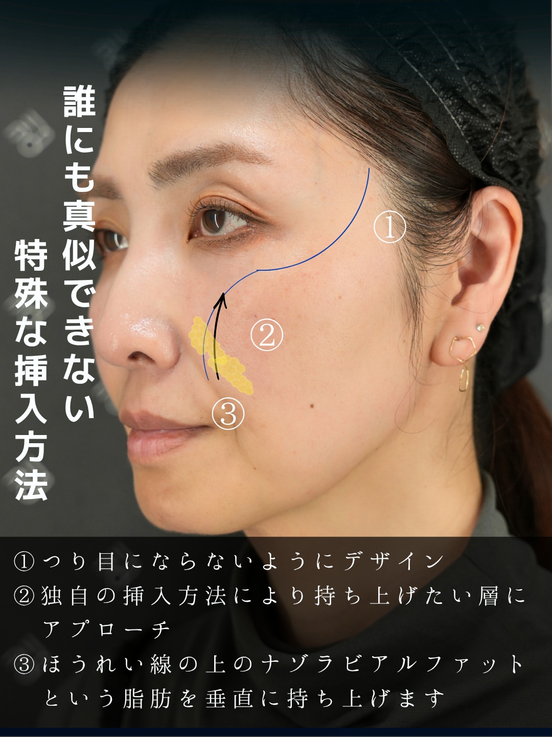バーティカルリフトプレミアム