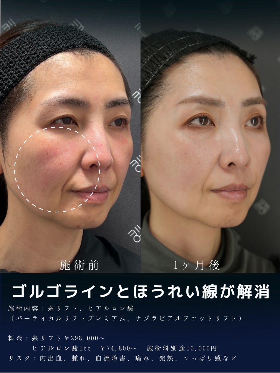 バーティカルリフトプレミアム
