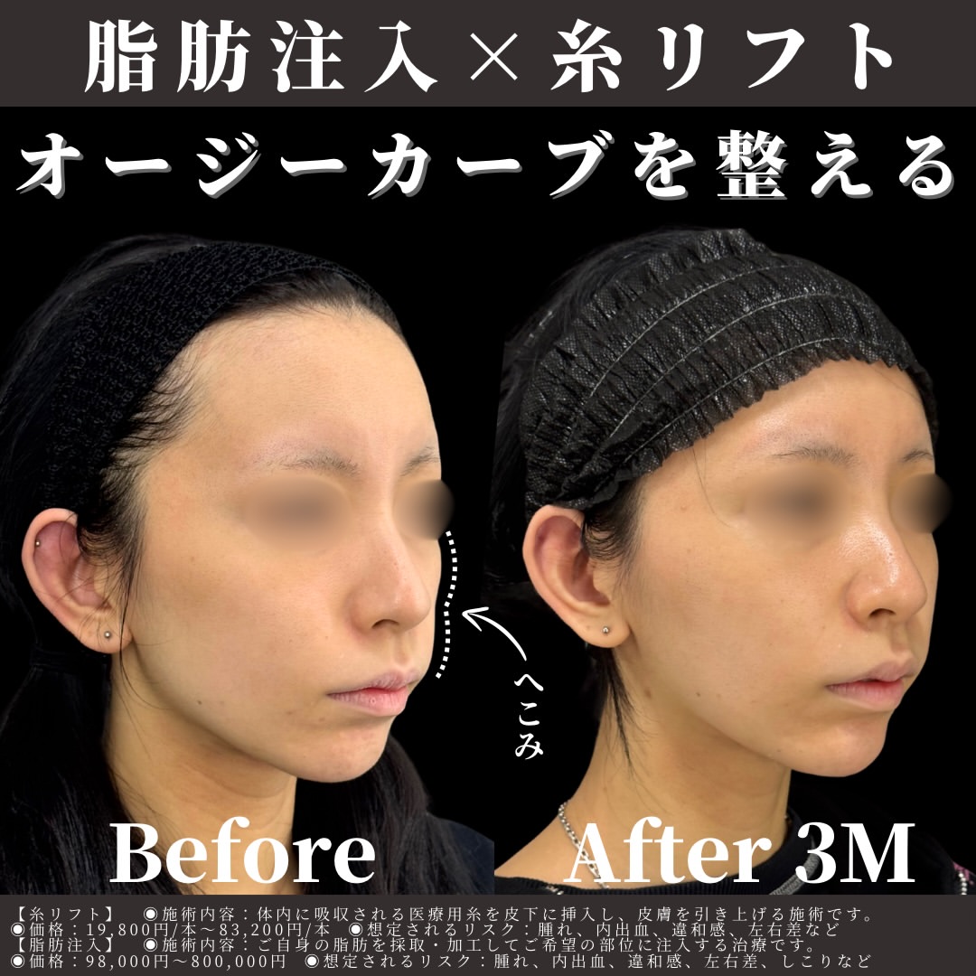 脂肪注入×糸リフト